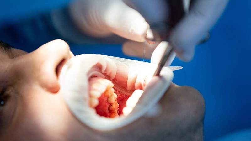 Gum inflammation or periodontal disease